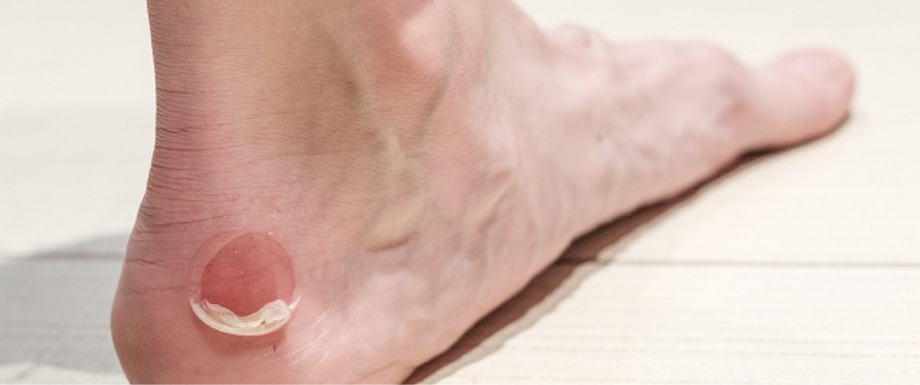 Diabetes and Feet – Blisters